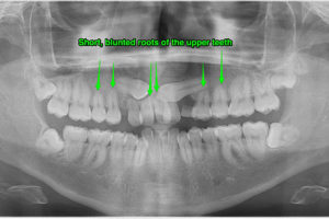 supplemental treatment consent short blunted roots on the upper teeth