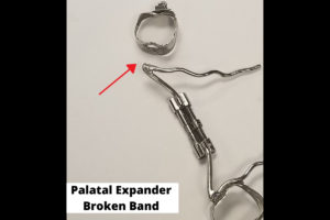 broken expander with broken band