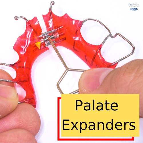 Palate Expanders The Most Important Orthodontic Appliance