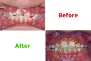 Anterior crossbite before and after