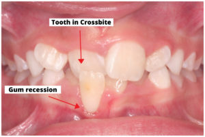 single-tooth-anterior-crossbite