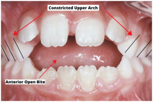 anterior-open-bite