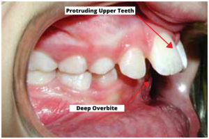 protruding upper teeth